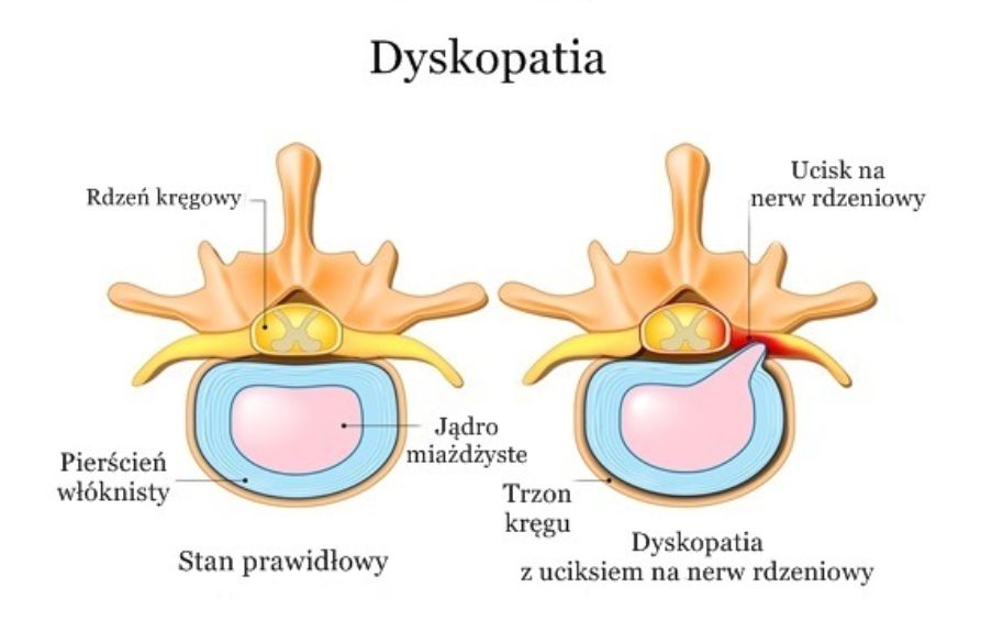 Dyskopatia